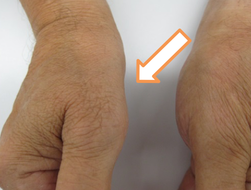 Bild Carpal tunel